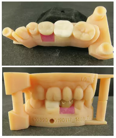 Abb. 57 u. 58: Die Printmodelle von 3D Medical Print mit der mitgelieferten PMMA-Krone von Atlantis, deren Passung ebenfalls sehr gut war.