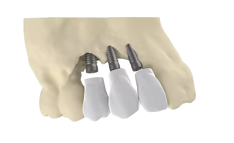 2. Schritt