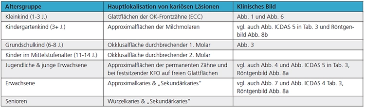 Tab. 2: Altersspezifische Hauptlokalisation von (neuen) kariösen Läsionen bei Kindern, Jugendlichen und Erwachsenen.