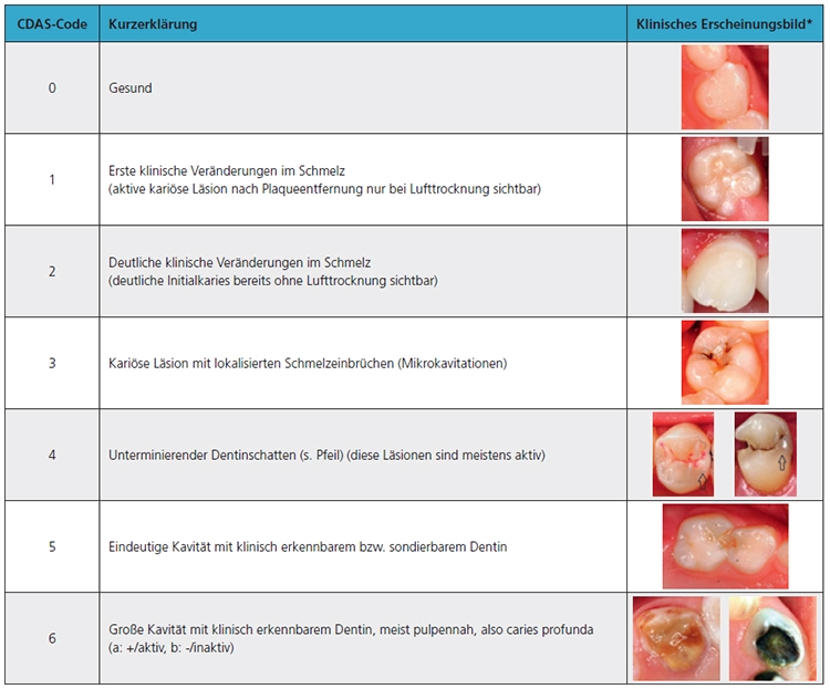Tab. 3: Neuere präzisere Klassifikation von kariösen Läsionen nach dem International Caries Detection and Assessment System (ICDAS).