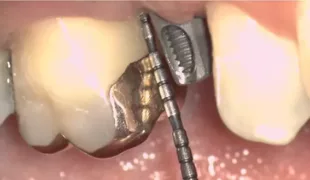 Die parodontale und periimplantäre Sondierung spielt in der parodontalen und periimplantären Diagnostik eine zentrale Rolle.
