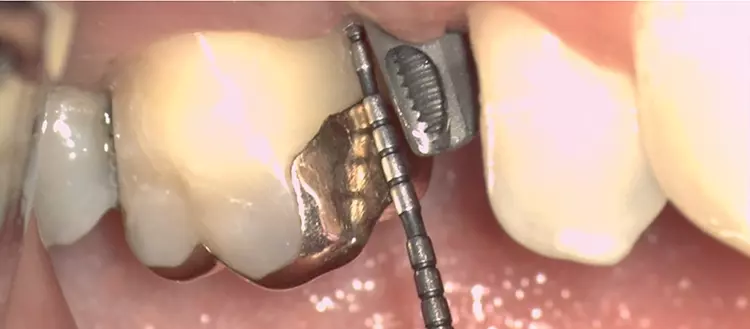 Die parodontale und periimplantäre Sondierung spielt in der parodontalen und periimplantären Diagnostik eine zentrale Rolle.