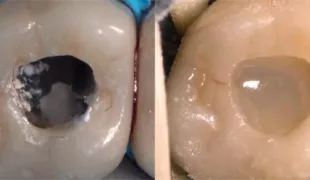 Ausgangssituation vor der Präparation vs. Füllung der Kavität mit everX FlowTM.