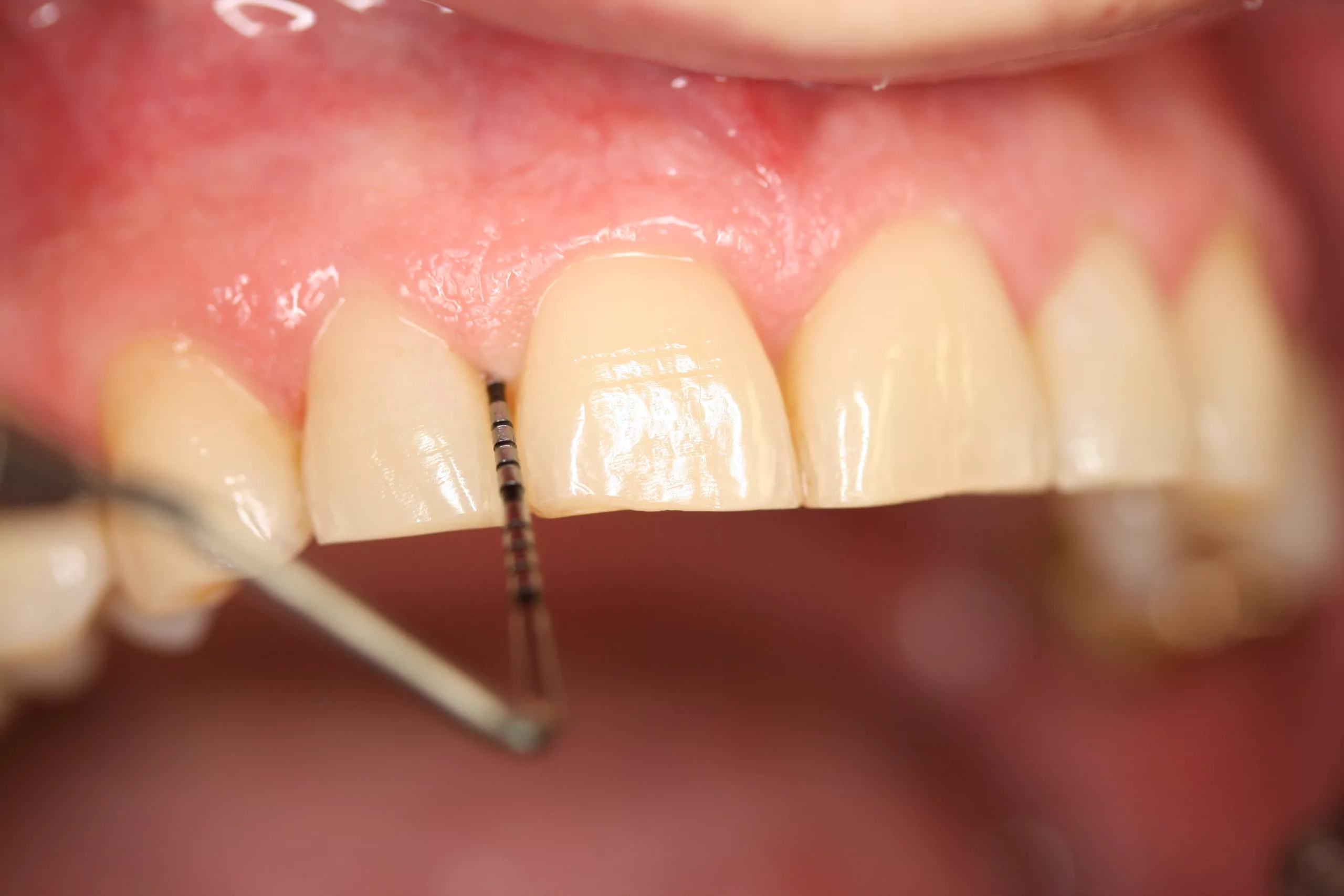 Abb. 1: Leichte Zahnfleischtasche an Zahn 12.