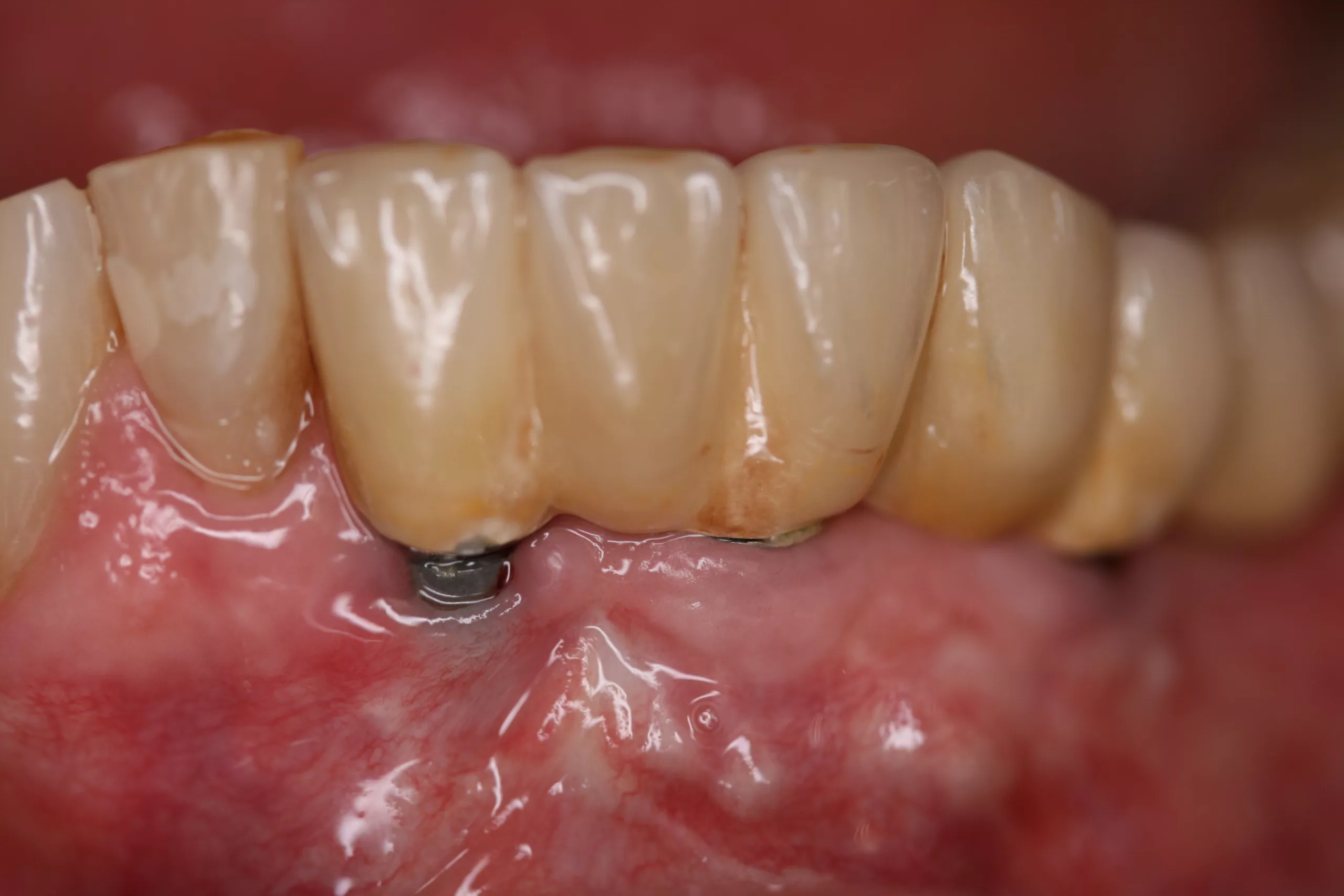 Abb. 2: Entzündete Mukosa an Implantat 41.