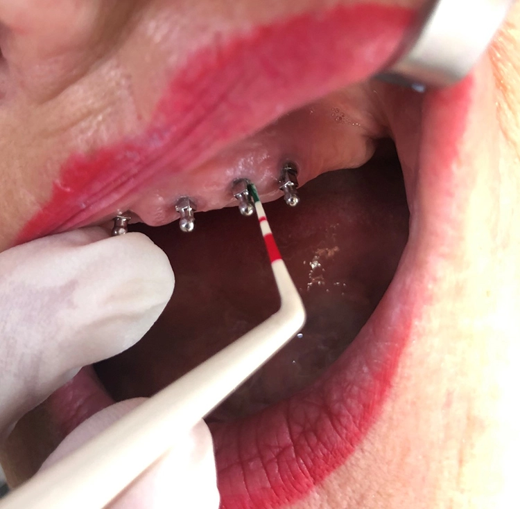 Abb. 7: Untersuchung des Knochenabbaus mit Sonde.