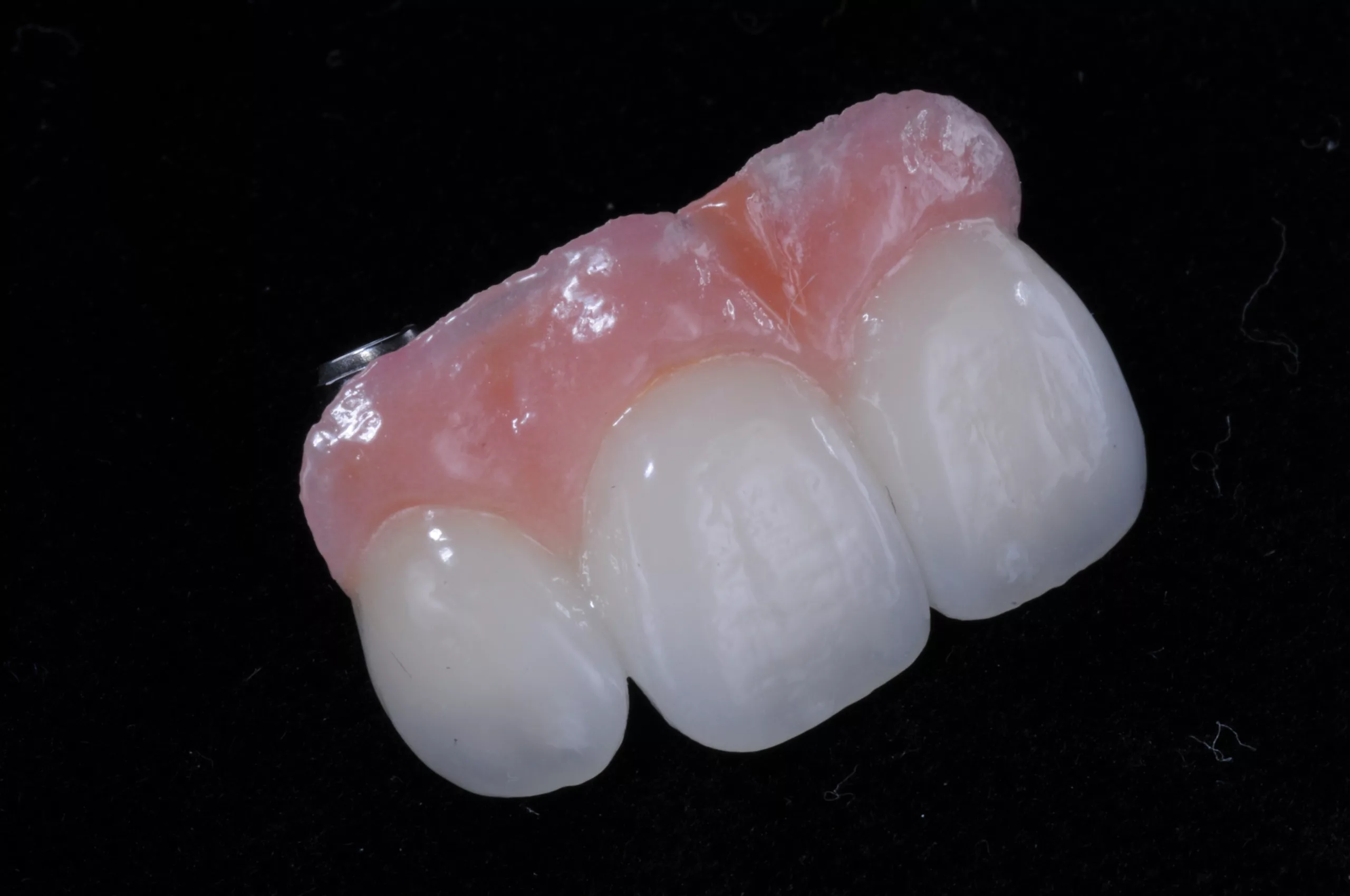 Ästhetische IPS Style Metallkeramik mit Oxyapatit.