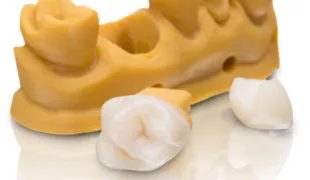 VarseoSmile Crown – das erste Varseo-Material für den 3D-Druck permanenter Einzelkronen – zeichnet sich durch hohe Festigkeit, geringe Wasseraufnahme und eine zahnhartsubstanzschonende Festigkeit.