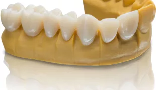 3D-gedruckte Versorgungen aus VarseoSmile Temp sind als Kurz- und Langzeitprovisorien für den Front- und Seitenzahnbereich geeignet.