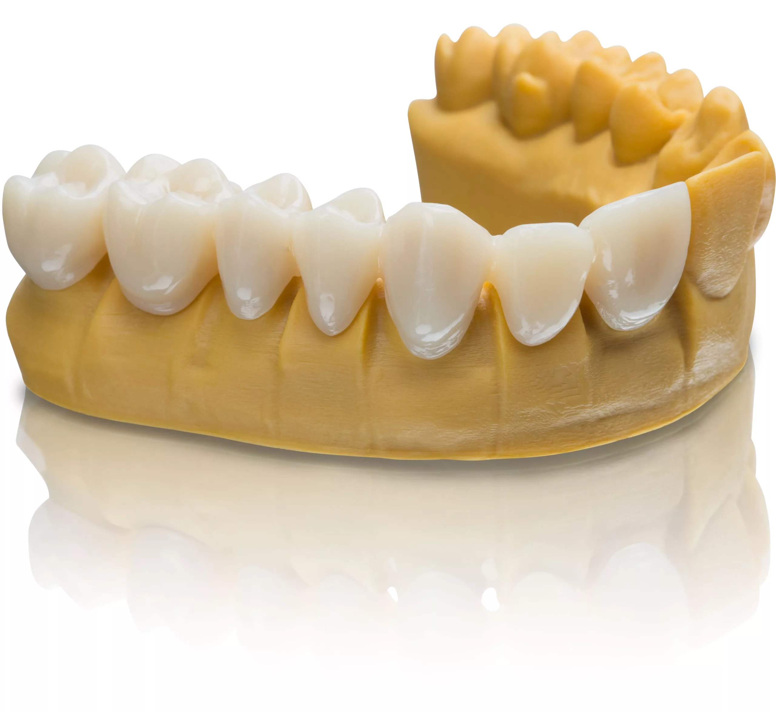 3D-gedruckte Versorgungen aus VarseoSmile Temp sind als Kurz- und Langzeitprovisorien für den Front- und Seitenzahnbereich geeignet.