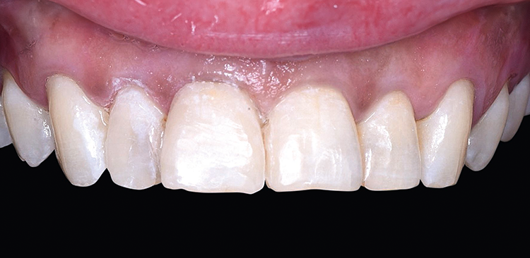Monochromatische Restauration mit Venus Diamond MEDIUM.
