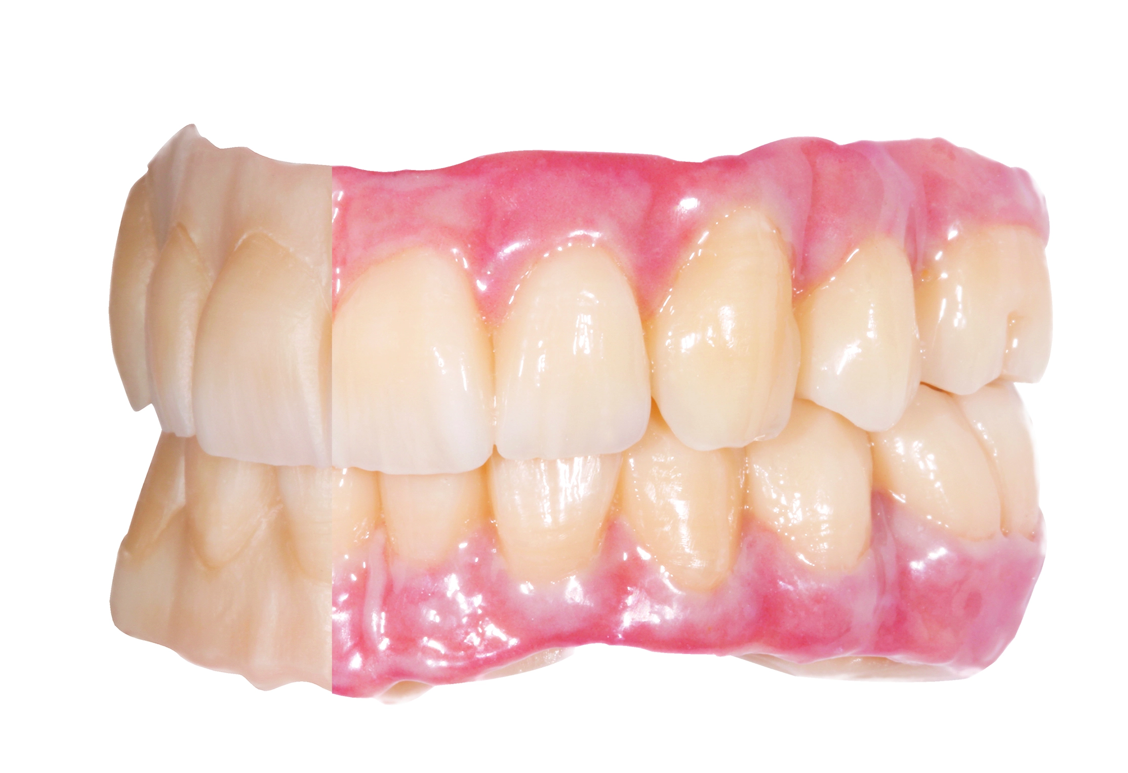 Implantatgetragene Versorgung aus Zirkonoxid mit und ohne ceraMotion® One Touch Verblendung.