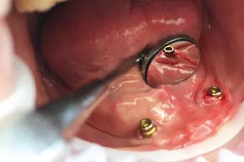 Abb. 1: Ausgangssituation: Gerötete und geschwollene entzündete Mundschleimhaut an Implantat 33.