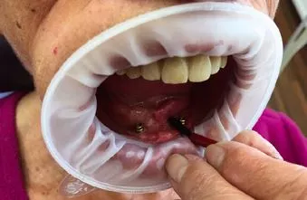 Abb. 2: Lokale Applikation von Kamillan® an entzündeter Gingiva und Mukosa rund um das Implantat.