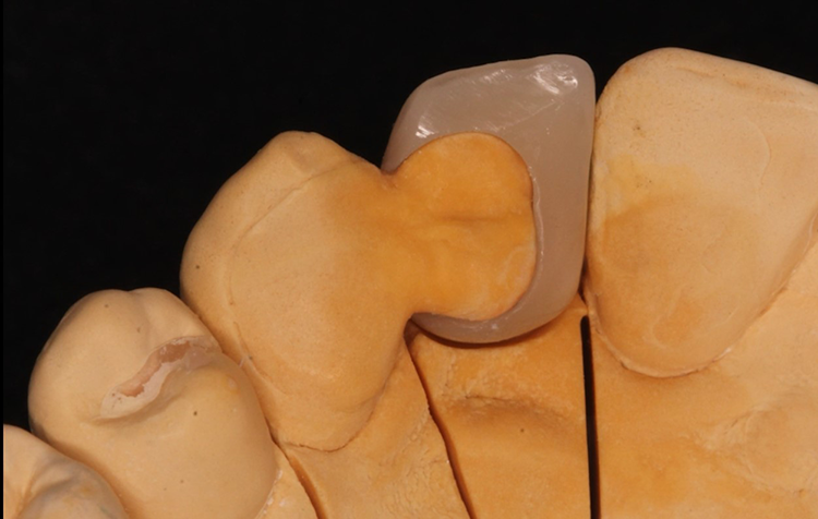 Abb. aus einer der drei prämierten Arbeiten des AGK Videopreises 2023: „Minimalinvasive Lösungen“ von Dr. Christine Yazigi, Universitätsklinikum Schleswig-Holstein – Campus Kiel, Klinik für Zahnärztliche Prothetik, Propädeutik und Werkstoffkunde.