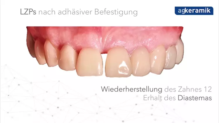 Digitale Herstellung der non-prep Langzeitprovisorien.