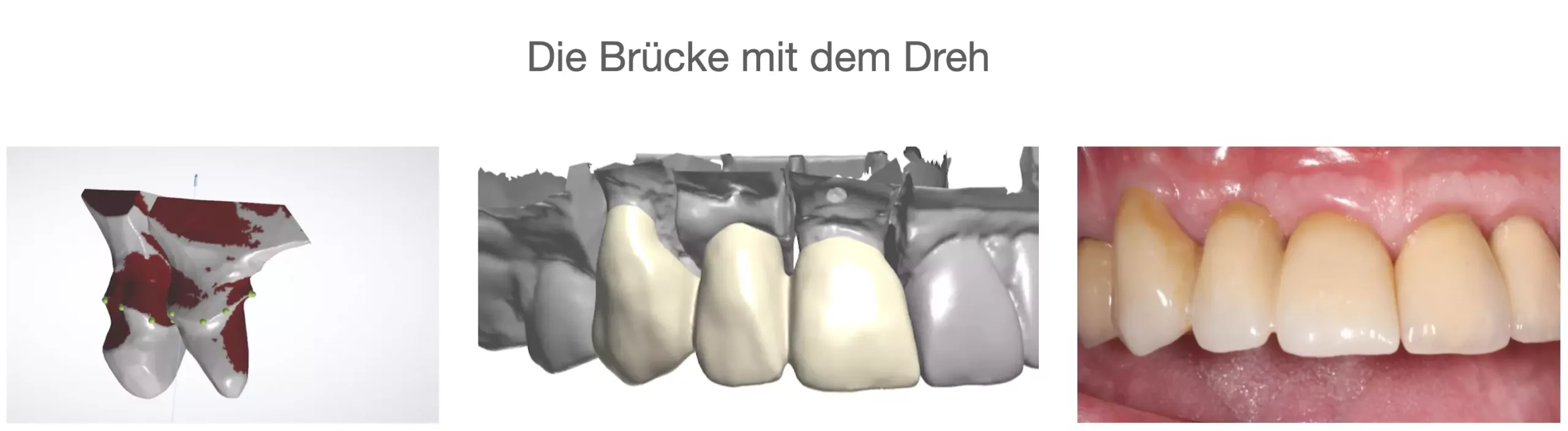 „Die Brücke mit dem Dreh“ – Impressionen aus dem Gewinnervideo des Filmfestivals 2020 von ZT Reinhard Busch, Universität Kiel.