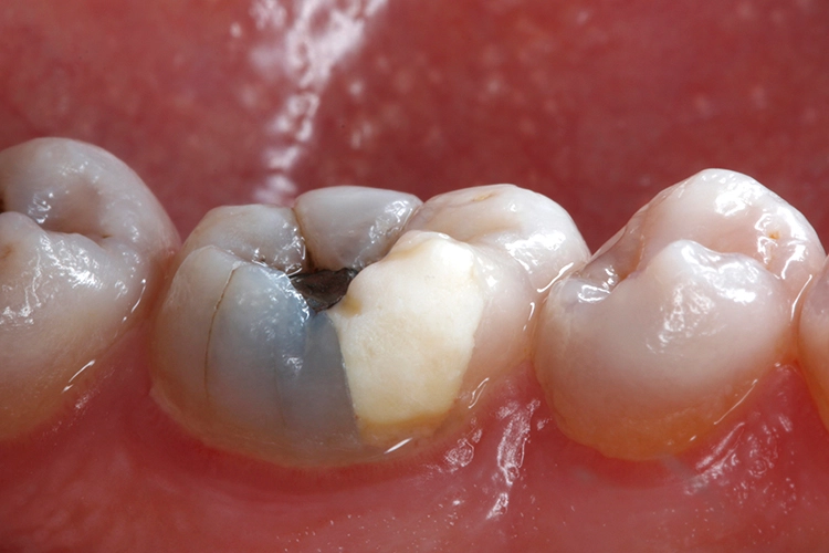 Abb. 2: Der Defekt erstreckt sich bis auf Höhe der marginalen Gingiva.