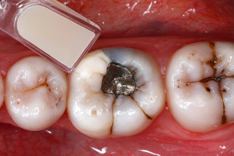 Abb. 3: Auswahl der passenden Kompositfarbe.