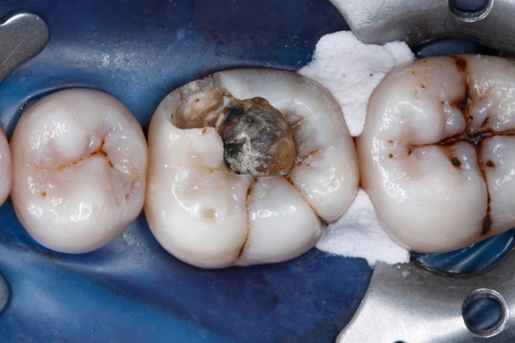 Abb. 4: Nach dem Anlegen von Kofferdam wurden die Füllungen entfernt.