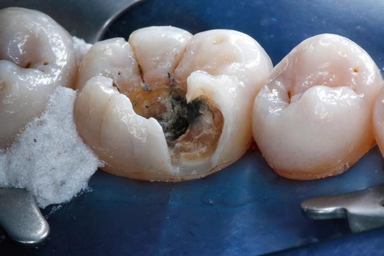 Abb. 5: Der Bereich unter dem frakturierten Höcker ist deutlich kariös verändert.