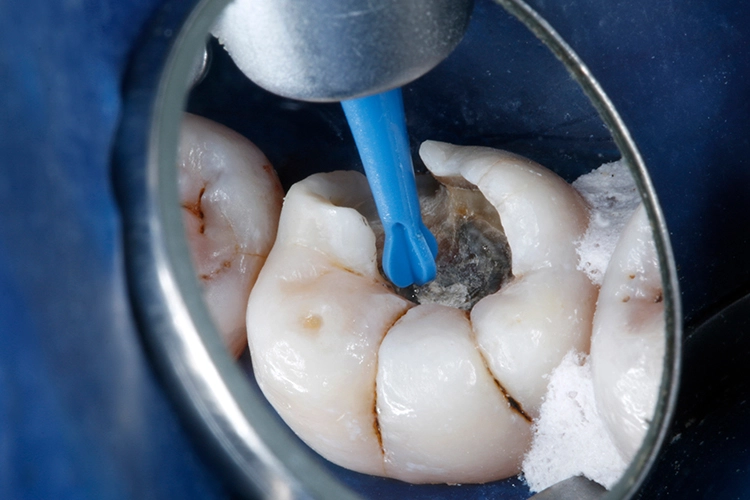 Abb. 7: Die pulpanahen Areale wurden mit einem selbstlimitierenden Polymer-Rosenbohrer substanzschonend exkaviert.