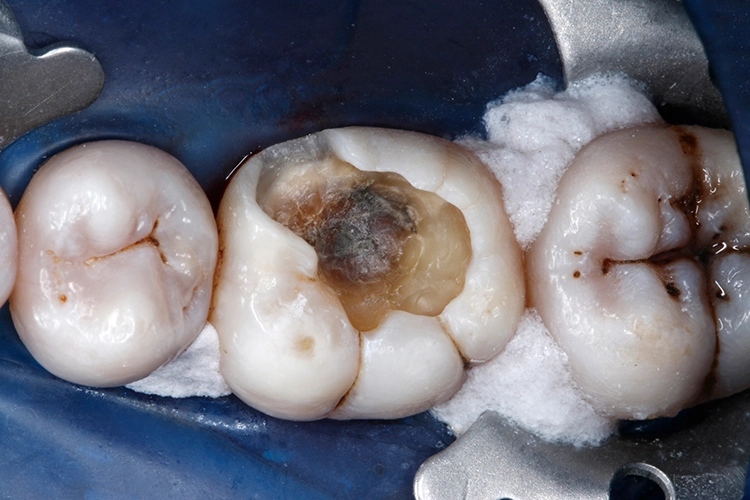 Abb. 8: Situation nach dem Entfernen der Karies und Finieren der Kavitätenränder.