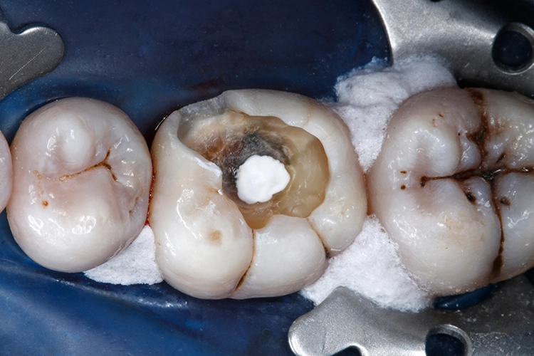 Abb. 9: Indirekte Überkappung des pulpanahen Dentins mit einer dünnen Schicht Calciumhydroxidpaste (Calcicur, VOCO) auf wässriger Basis.