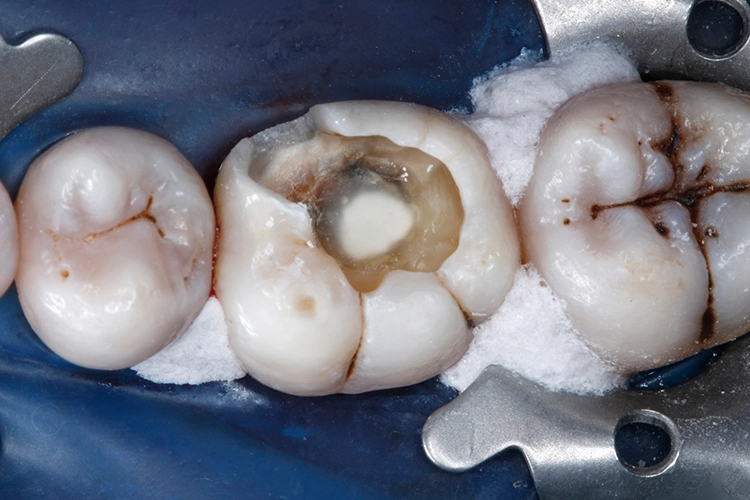 Abb. 10: Das Calciumhydroxidpräparat wurde mit einer partiellen Unterfüllung aus lichthärtendem kunststoffmodifiziertem Glasionomerzement (Ionoseal, VOCO) abgedeckt.