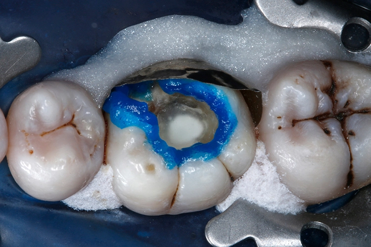 Abb. 12: Applikation von 35%igem Phosphorsäuregel (Vococid, VOCO) auf den Zahnschmelz (selektive Schmelzätzung).