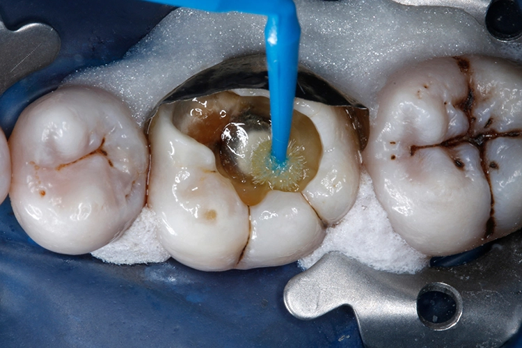 Abb. 13: Applikation des Haftvermittlers Futurabond U mit einem Minibürstchen auf Schmelz und Dentin.