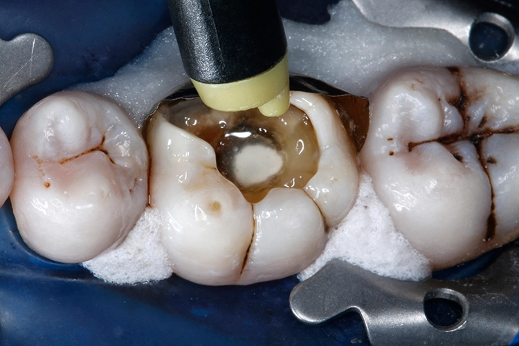 Abb. 14: Das Lösungsmittel wird mit trockener, ölfreier Druckluft vorsichtig verblasen.