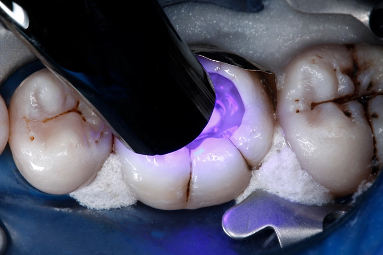 Abb. 15: Lichtpolymerisation des Haftvermittlers für 10 Sek.