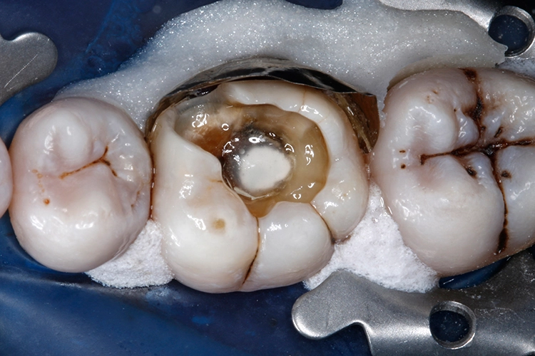 Abb. 16: Nach dem Auftragen des Adhäsivs zeigt die versiegelte Kavität in allen Bereichen eine glänzende Oberfläche.