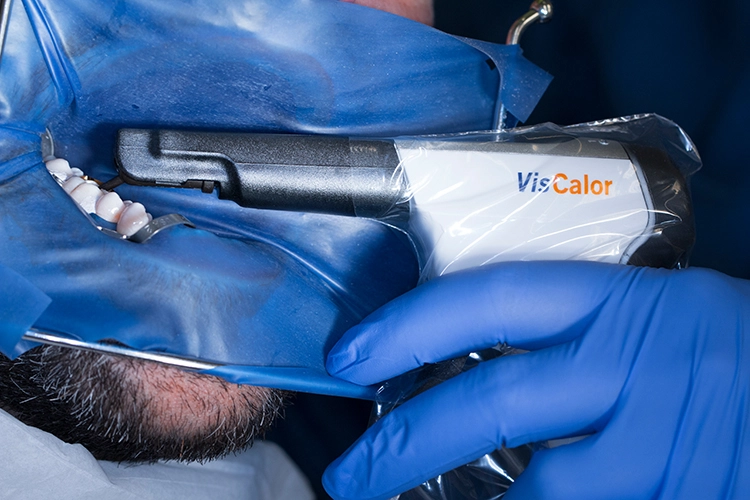 Abb. 17: Das thermoviskose Komposit VisCalor wird im heizbaren VisCalor Dispenser auf 65 °C erwärmt und dann direkt aus dem Dispenser in die Kavität appliziert.