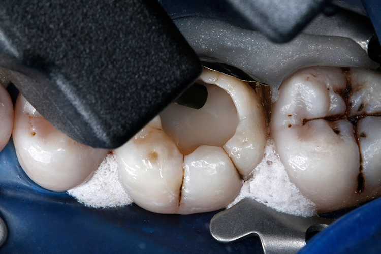 Abb. 18: Die schmale, biegsame Kanüle der VisCalor-Kompule erleichtert eine direkte Applikation des Füllungsmaterials auch in schwer zugängliche Bereiche und enge Kavitätenareale.