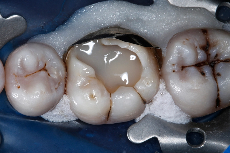 Abb. 19: Im 1. Schritt wurde die Kavität mit einem 2-mm-Inkrement bis ca. zur Hälfte derDefekthöhe mit VisCalor gefüllt. Das Material zeigt ein hervorragendes Anfließverhalten an die Kavitätenwände.