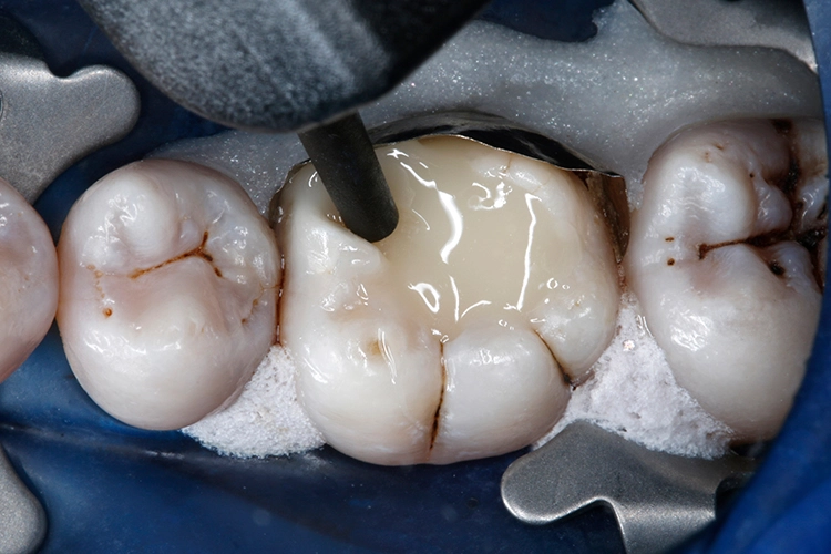 Abb. 21: Mit dem 2. 2-mm-Inkrement VisCalor wird das komplette Restvolumen der Kavität gefüllt.