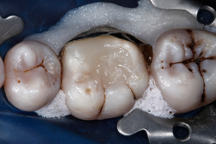 Abb. 22: VisCalor kühlt innerhalb weniger Momente nach Kontakt mit dem Zahn durch Wärmeleitung (Konduktion) schnell wieder auf Mundhöhlentemperatur ab und nimmt wieder eine hochviskose
Konsistenz an.