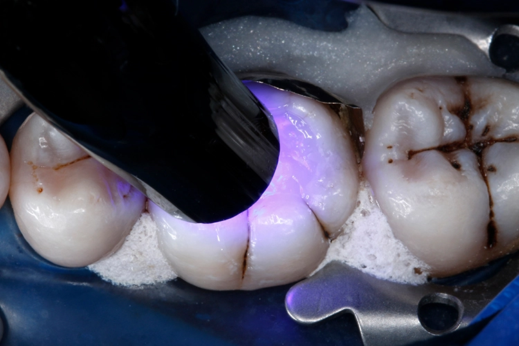 Abb. 23: Polymerisation der 2. Schicht des Füllungsmaterials für 10 Sek.