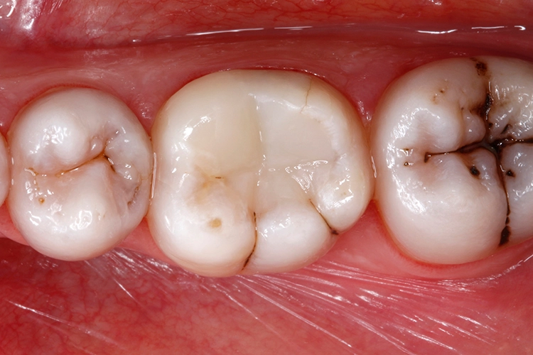 Abb. 24: Endsituation: fertig ausgearbeitete und hochglanzpolierte Kompositrestauration. Die Funktion und Ästhetik des Zahnes sind wiederhergestellt.
