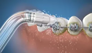 Waterpik® Orthodontic Düse speziell für Zahnspangen und orthodontische Applikationen.