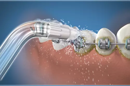 Waterpik® Orthodontic Düse speziell für Zahnspangen und orthodontische Applikationen.