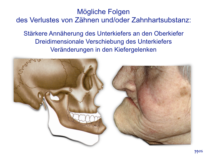 Abb. 2b: Zahnhartsubstanz- und Zahnverlust führen zu Veränderungen in der Kieferrelation.