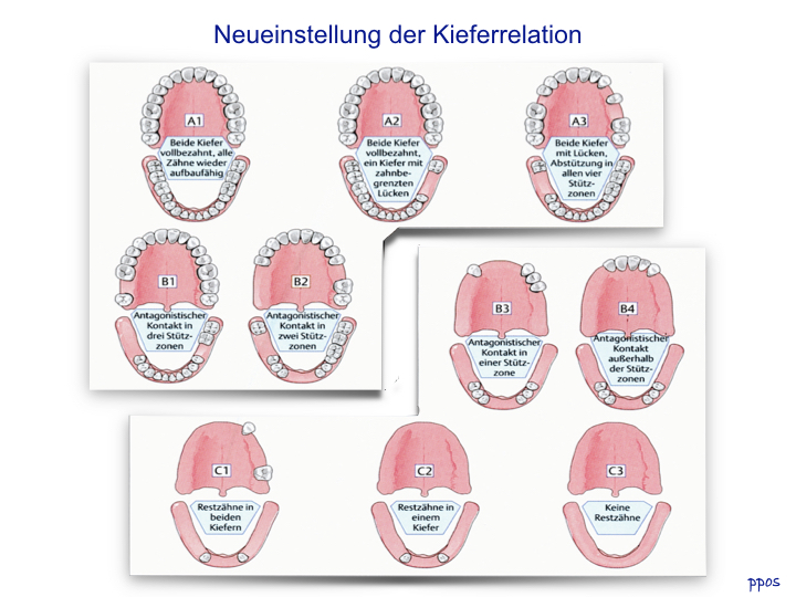 Abb. 3: Darstellung der Eichner-Klassifikation: Ab Eichner-Klasse B 3 sollte eine Neueinstellung der Kieferrelation erfolgen.