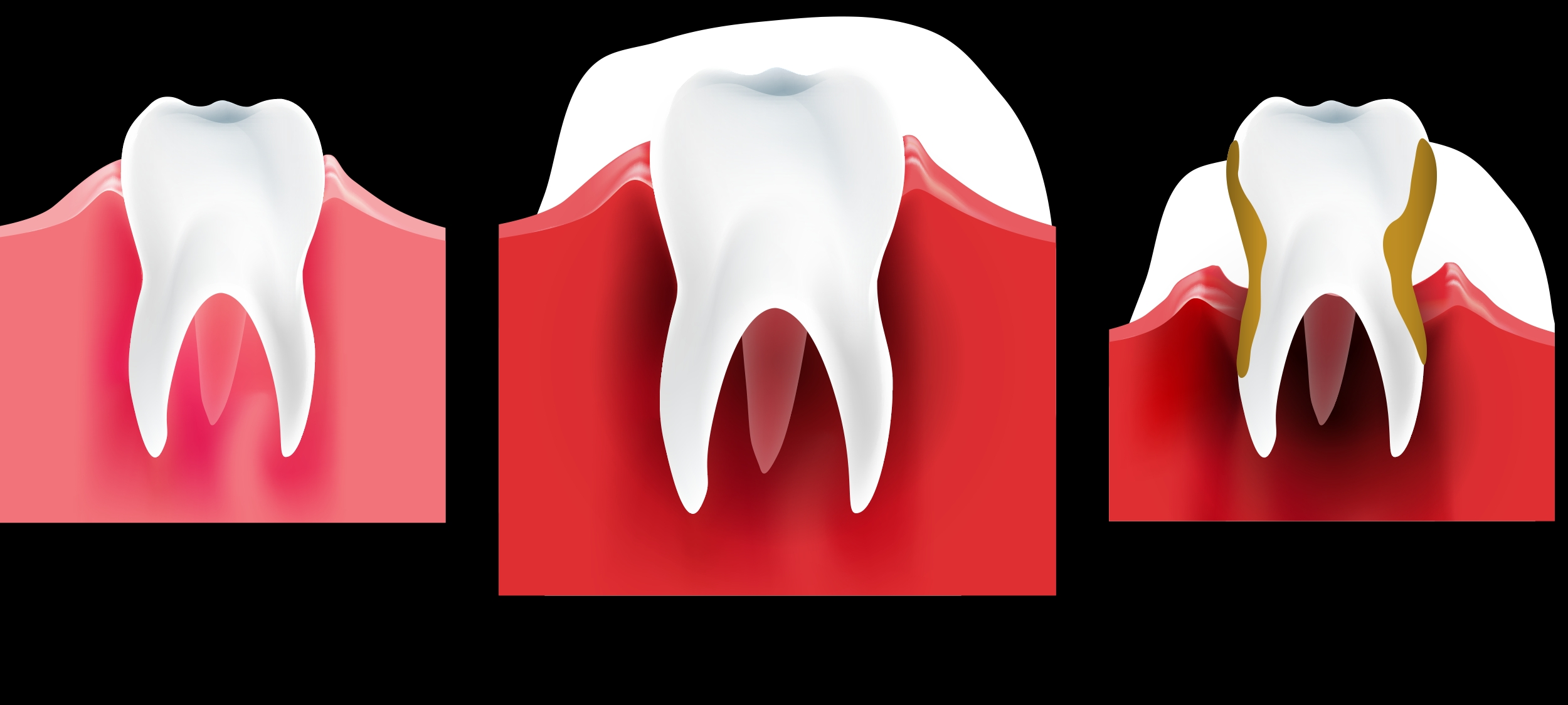 Bild 1: Gesundes Zahnfleisch (links), Gingivitis (Mitte) und Parodontitis (rechts).