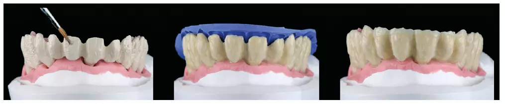 Abb. 13: Silanisieren und Opakern des Gerüstes sowie Abdecken des Dentinkerns.