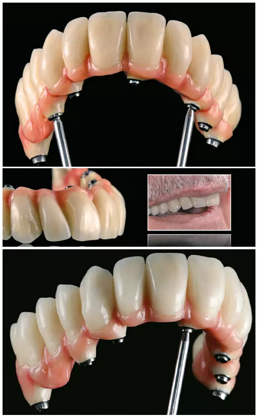17a–c: Impressionen der fertig verblendeten implantatgestützten und bedingt herausnehmbaren Oberkieferversorgung.