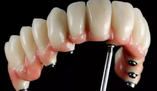 Fertig verblendete implantatgestützte und bedingt herausnehmbare Oberkieferversorgung.