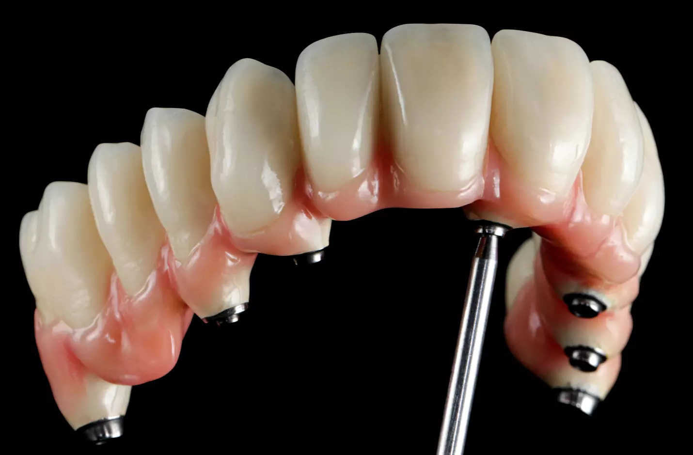 Fertig verblendete implantatgestützte und bedingt herausnehmbare Oberkieferversorgung.